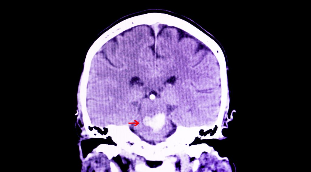 CT scan showing an intracranial hemorrhage