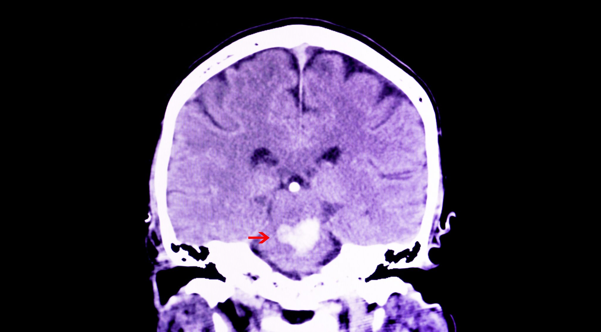 Кровоизлияние ствола мозга. Subarachnoid Hemorrhage CT. Орбитальное кровоизлияние. Краниофарингиома гистология.